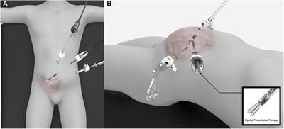 Laparoscopic transabdominal preperitoneal herniorrhaphy performed using an articulating laparoscopic instrument is feasible and more efficient